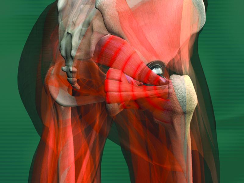 Artroplastia de cadera